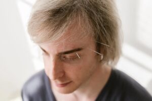 Dry Needling and Its Role in Managing Migraine Headaches
